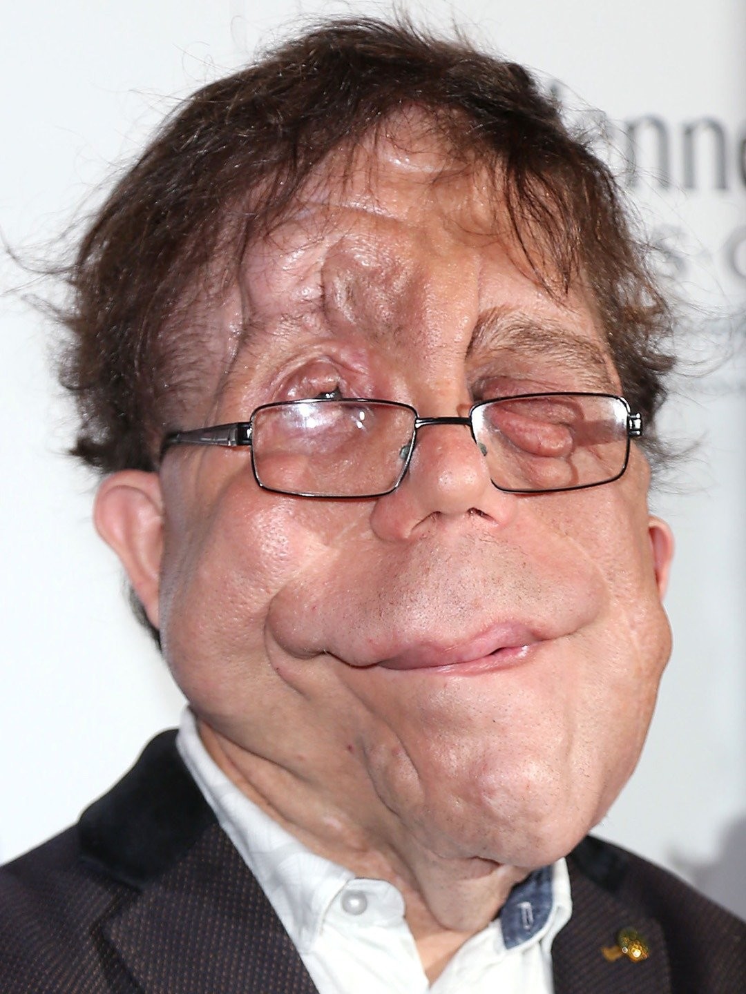 Adam Pearson Pictures Rotten Tomatoes