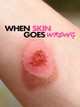 When Skin Goes Wrong